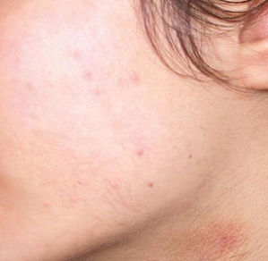 sugaring before and after