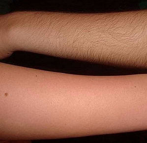 sugaring before and after