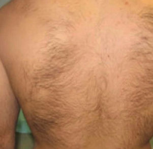 sugaring before and after