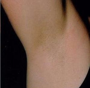 sugaring before and after