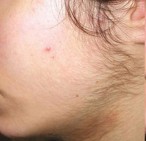 sugaring before and after