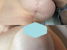 3 Types of Scars From Breast Lift Surgery - and how to remove them