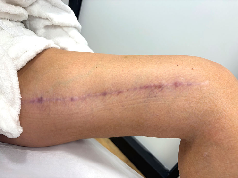 Thighplasty Scar Camouflage
