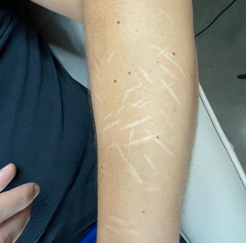self harm scar cutting scar removal dallas