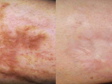 Camouflage Tattoo vs Laser Scar Removal