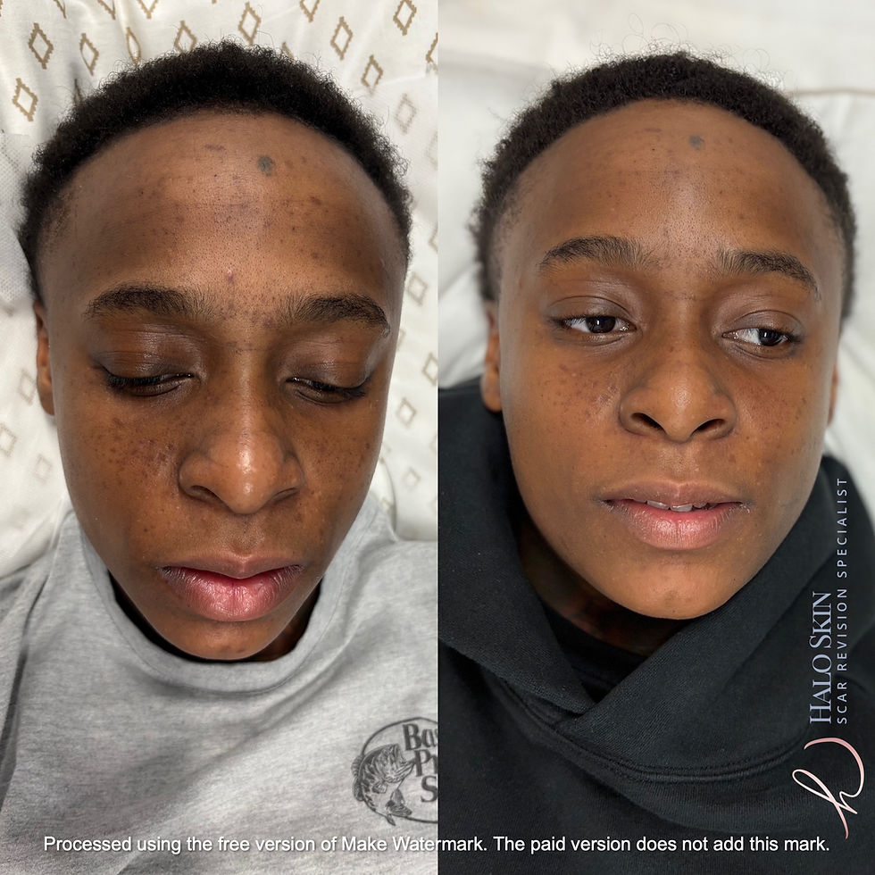 hyperpigmentation facial Dallas Texas