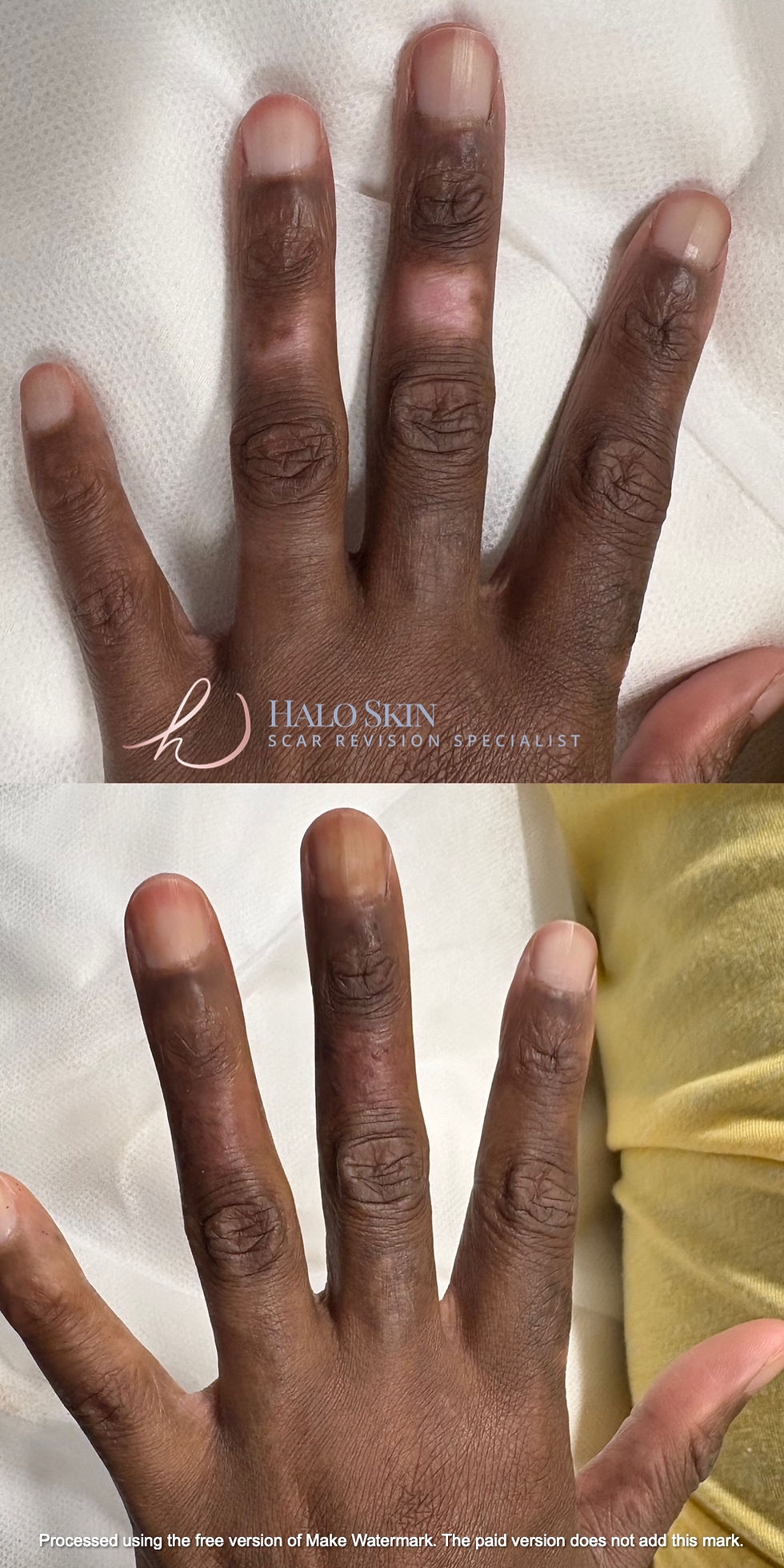 vitiligo scar camouflage - Dallas, TX