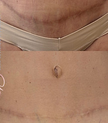 tummy tuck scar camouflage halo skin and scar dallas.JPG
