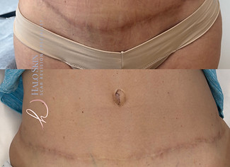 tummy tuck scar camouflage halo skin and scar dallas.JPG