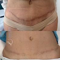 tummy tuck scar camouflage halo skin and scar dallas.JPG