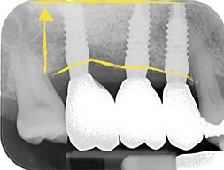 Radiografia post intervento di inserimento impianti dentali