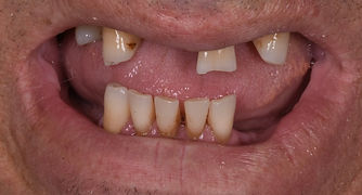 Problematica dentale di caduta dei denti