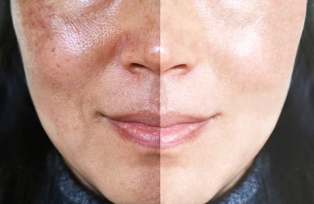 Solving hyperpigmentation using chemical peels. 5 TIP | 01.02