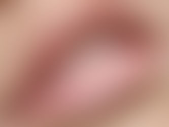 Preenchimento Labial