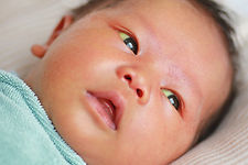 Baby with jaundice-.jpg