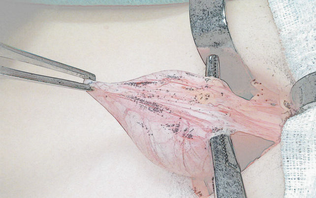 Imagem de cirurgia de orquidopexia para tratar criptorquidia - Dr Domingos Bica - Urologista Pediátrico