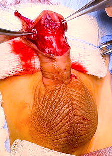 Urologia Pediátrica - Dr. Domingos Bica | Especialista na correção cirúrgica das hipospádias. Referência nacional. Especialização no Children's Hospital of Philadelphia.