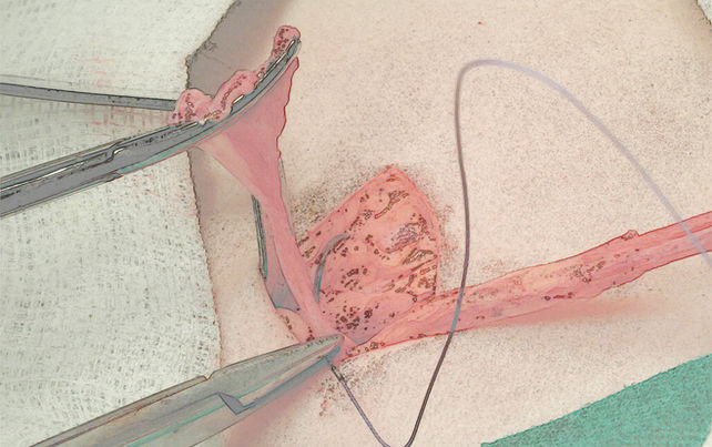 Imagem de cirurgia de orquidopexia para tratar criptorquidia - Dr Domingos Bica - Urologista Pediátrico