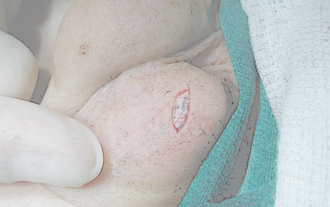 Imagem de cirurgia de orquidopexia para tratar criptorquidia - Dr Domingos Bica - Urologista Pediátrico