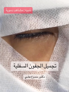 تجميل الجفون السفلية ؟