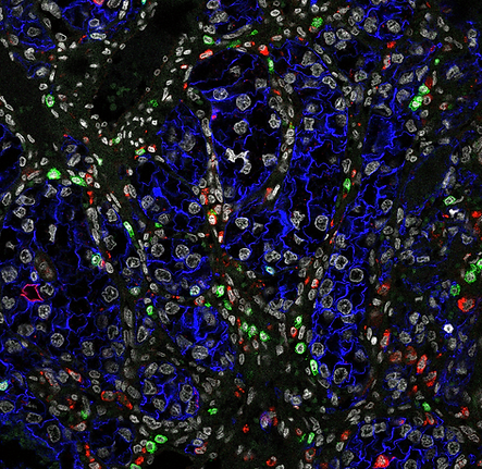 Renal Thrombus CD3 CD68 CA9.tif