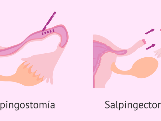 Salpingectomía para la prevención del cáncer de ovario