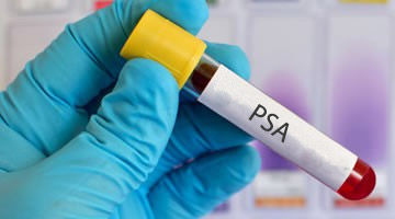 Recomiendan limitar la prueba de PSA