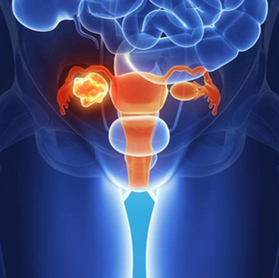 Superar al cáncer de ovario con una sola cirugía