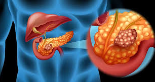 Estudio de historias clínicas predice el riesgo de cáncer de páncreas