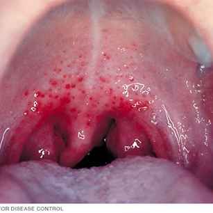 Nuevas directrices para diagnóstico de faringitis estreptocócica