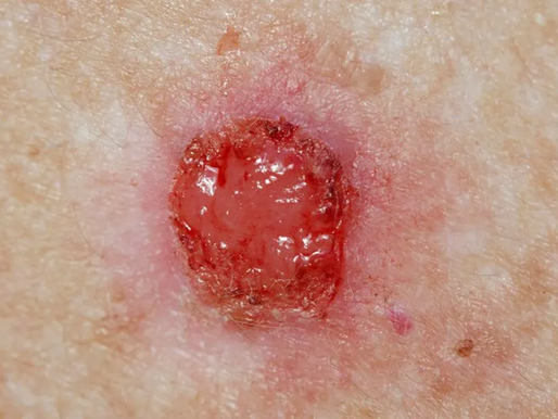 Melanoma: Aumento de las tasas de cáncer de piel