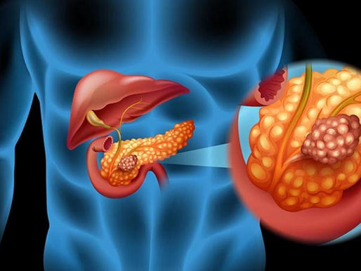 Diagnóstico de cáncer de páncreas 
