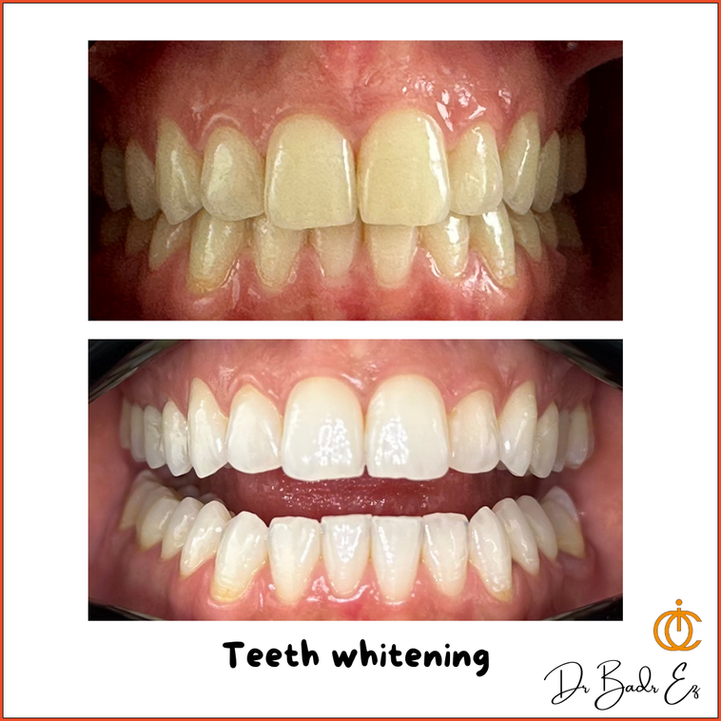 blanchiment dentaire rabat