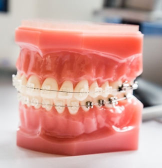 Orthodontie_FAQ_dentiste_Laval_edited.jpg