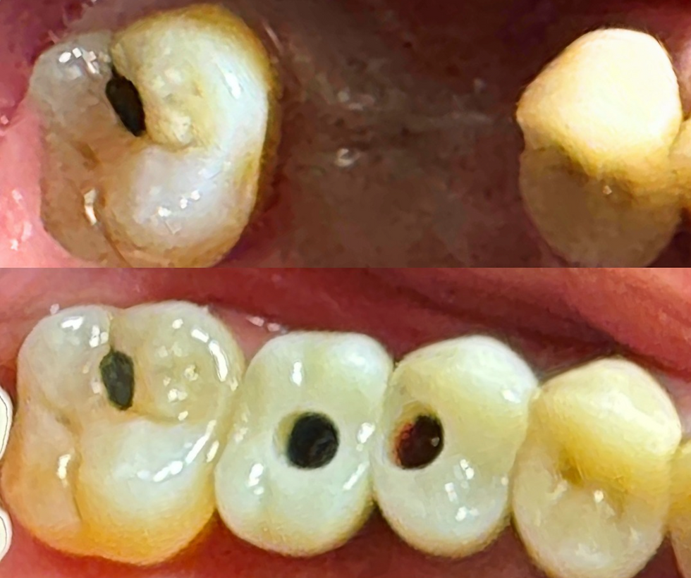Cross-sectional illustration comparing screw-retained and cement-retained implant crowns, highlighting zirconia crowns, screws, and fixture components.