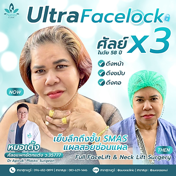 การผ่าตัดดึงหน้า/ดึงคอ (Facelift/Neck Lift) - การผ่าตัดดึงหน้า/ดึงคอ (Facelift/Neck Lift) -