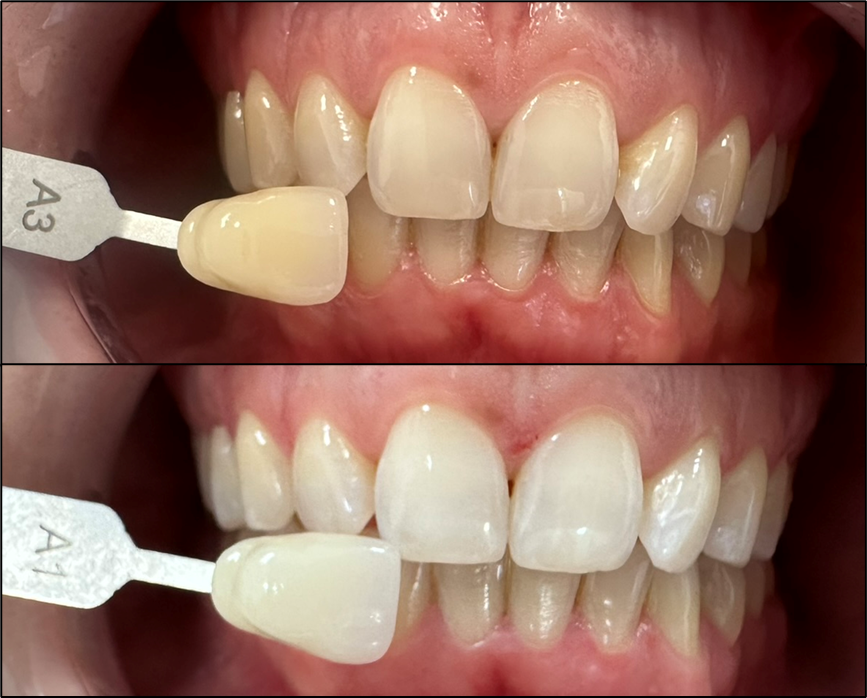 Blanqueamiento Dental: Todo lo que Necesitas Saber