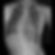 scoliosis xray