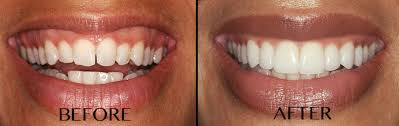 Hampstead Aesthetics Gummy Smile Treatment