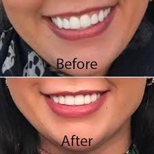 Gummy Smile Facial Rejuvenation Treatment by Hampstead Aesthetics
