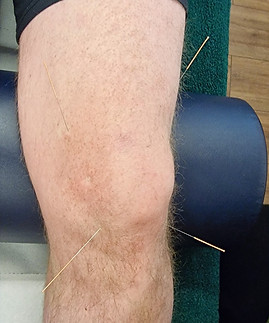 Rural Rehabilitation Skelmanthorpe Acupuncture