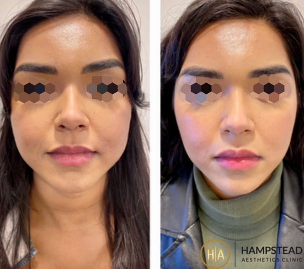 Hampstead Aesthetics Jawline Slimming Treatment
