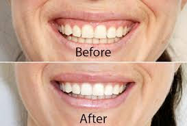 Gummy Smile Facial Rejuvenation Treatment by Hampstead Aesthetics