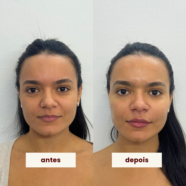 preenchimento labial e harmonização facial na clínica paola bastos.png