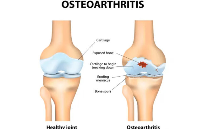 Arthritis Caused By This Childhood Trauma