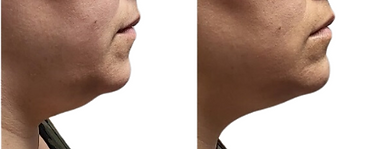FITTED CHIN 2.png