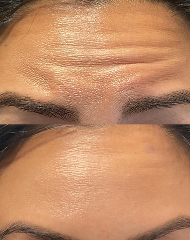 Frontalis Smoothing_edited.jpg