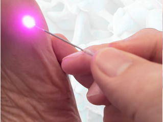 Laser Wart Therapy in Perrysburg Ohio