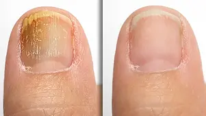 Toenail Fungus Treatment Perrysburg