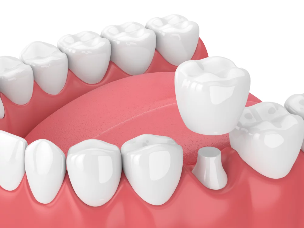 couronne-dentaire-prothese-dentaire.jpg.webp
